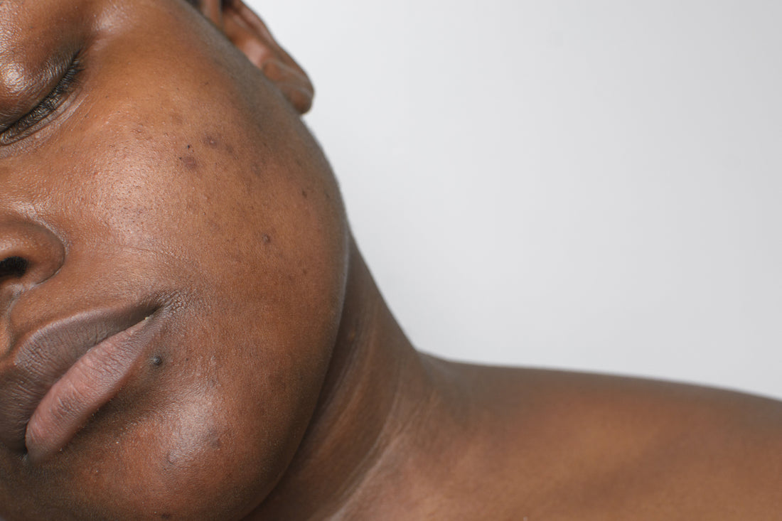 The Ultimate Guide to Fading Dark Spots Naturally for Melanin-Rich Skin